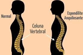 Espondilite anquilosante rouba em média 110 dias de trabalho por ano -  Artrite Reumatóide