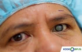 Check spelling or type a new query. Kode Icd 10 Katarak 2021 Penyebab Gejala Pengobatan Kodebpjs