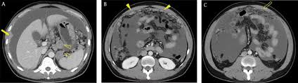 Malignant mesothelioma is a highly lethal malignancy of the serosal membranes of the pleura, peritoneum, pericardium, or tunica vaginalis testes. Peritoneal Carcinomatosis And Its Mimics Review Of Ct Findings For Differential Diagnosis