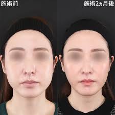 下膨れ ボトックス