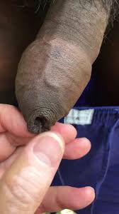 Phimosis tight foreskin - video 2 - ThisVid.com