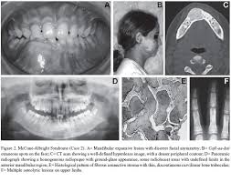 A disorder characterized by abnormalities in bone. Scielo Brasil Clinical Microscopic And Imaging Findings Associated To Mccune Albright Syndrome Report Of Two Cases Clinical Microscopic And Imaging Findings Associated To Mccune Albright Syndrome Report Of Two Cases