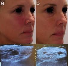 The average length of time between getting the first dose and having a skin reaction was eight days. Covid 19 Sars Cov 2 Virus Spike Protein Related Delayed Inflammatory Reaction To Hyaluronic Acid Dermal Fillers A Challenging Clinical Conundrum In Diagnosis And Treatment Springerlink