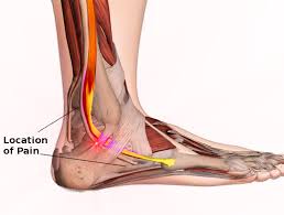 Next to the tibia is the fibula, Peroneal Tendon Syndromes Article