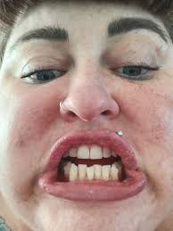 Invisalign treatment progress after 4 weeks