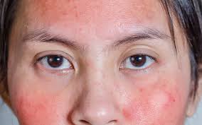 Image result for red rash face