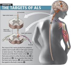 As these motor neurons are lost, the muscles they control become weak and then nonfunctional, thus leading to muscle weakness, disability, and eventually death. Amyotrophic Lateral Sclerosis Als And Wheelchair Bound