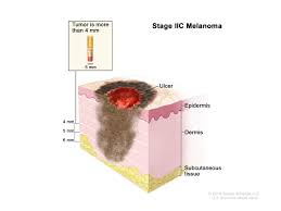 Actinic keratoses (aks) are common skin lesions caused by cumulative sun exposure. Melanoma Surgery Melanoma