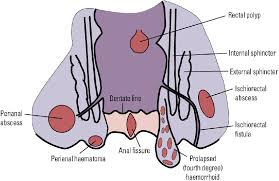 Image result for Perirectal Abscess