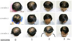 It's characterized by gradual thinning of your hair, which may be noticeable as a widening part or a ponytail that's less hefty than it used to be. Scientists Claim To Have Found An Extract From Mangrove Trees That Can Cure Baldness Daily Mail Online