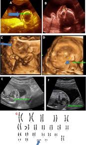 A look at what your scans will involve. The Diagnostic Performance Of 4d Ultrasound In Nuchal Translucency And Anomalies Association Sciencedirect
