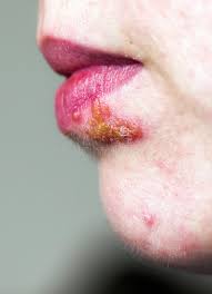 This is the same virus that causes chickenpox. Herpes Auf Lippe Stockfoto Bild Von Makro Gesicht Krankheit 97605104