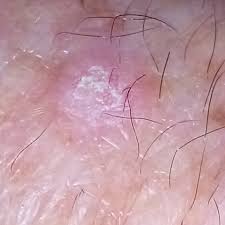 Epithelium 2 includes the skin surface and the inner linings of the respiratory, digestive. Squamous Cell Carcinoma Pictures Scc View Our Library