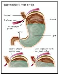 Image result for Pediatric Reflux
