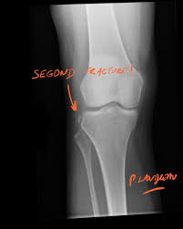 Image result for Segond Fracture