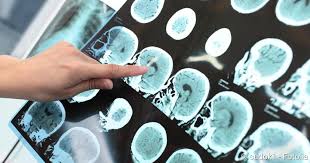 Schadel Hirn Trauma Symptome Behandlung Folgen Netdoktor