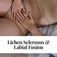 Image result for Labial Fusion