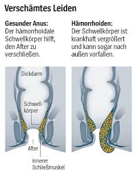 Hamorrhoiden Feigwarzen Oder Marisken Wenn Es Am Po Juckt Der Spiegel