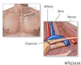 Thoracic outlet syndrome Information | Mount Sinai - New York