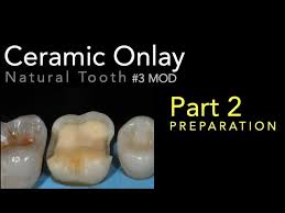 Ceramic Onlay Part 2 Preparation Youtube