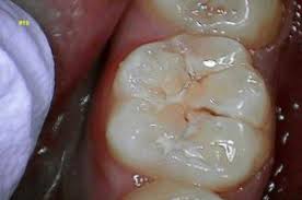 Dental sealants can prevent cavities in children and adults for years, but are they worth the cost and as soon as your child is getting new teeth in with grooves called 'pits and fissures' like molars and. Dental Sealants Protect Teeth From Decay Stop Tooth Decay In Moorestown Nj