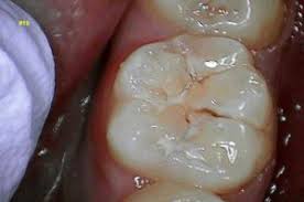 Sealants of the primary molars soon after they erupt would reduce the total caries experience of the the aim of this study is to measure the caries preventive effect of sealants in primary molars. Dental Sealants Protect Teeth From Decay Stop Tooth Decay In Moorestown Nj