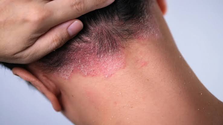 Psoriasis skin patches close-up