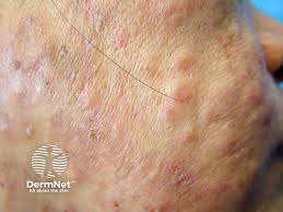 Image result for skin rash acute hiv infection