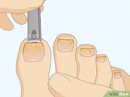 This is because they have an easier time spreading between an infected person and 1.6 other related articles: How To Cure Toenail Fungus Can Vinegar Help