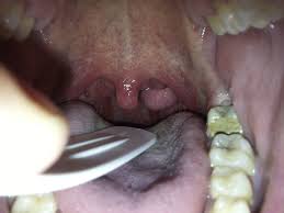 Infección en la lengua por sexo oral