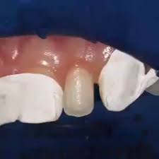 Microdontia Video Dental Anatomy Dental Aesthetics Dental