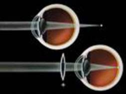 Image result for Refractive Error