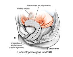 All or part of the müllerian tract fails to form, or is extremely underdeveloped. Mrkh Cosmetic Vaginal Surgery Atlanta Urogyn Beverly Hills Vaginal Rejuvenation Mrkh Atlanta Neovagina Creation Beverly Hills Mayer Rokitansky Kuster Hauser