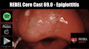 Image result for Epiglottitis