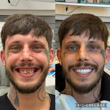 A switch from a bone reducing procedure to a bone conserving procedure. FP1  should be a tool every full arch provider has in their belt. @3.on.6 gave  this amazing man a new