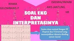 Maybe you would like to learn more about one of these? Soal Dan Cara Menginterpretasikan Ekg Part 2 Youtube