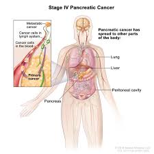 Pancreatic cancer can cause diarrhoea (runny poo) and constipation (when you find it harder to poo). Pancreatic Cancer Hematology Oncology Associates Of Cny