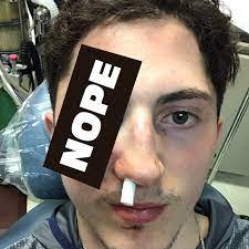 All eyes are on the eye of zach werenski. This Is What Your Eyeball Looks Like After A Puck Hits It Courtesy Of Zach Werenski Sbnation Com