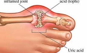 What Is A Gout Attack What Causes It How Do You Treat It Home Remedies For Gout Essential Oils For Gout Gout Remedies