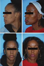 Cosmetic Treatments with Energy-Based Devices in Skin of Color
