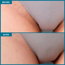 We did not find results for: Bikini Area Laser Hair Removal Milan Laser In Asheville Nc