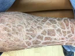 Image result for Ichthyosis