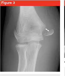 This fracture is the second most common distal humerus fracture in children. Medial Epicondyle Fractures In The Pediatric Population Semantic Scholar