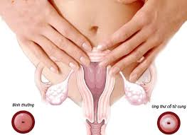 Bạn có thể chữa khỏi ung thư cổ tử cung có thể nếu phát hiện bệnh sớm. Bá»‡nh Ung ThÆ° Cá»• Tá»­ Cung Va Nhá»¯ng Ä'iá»ƒu Phá»¥ Ná»¯ Cáº§n Biáº¿t
