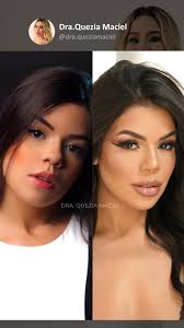 Perfil novo, sem cirurgia. 🪄 Com a minha técnica de perfiloplastia,  conseguimos harmonizar o rosto dessa paciente, projetando o mento e  suavizando o aspecto da papada. Tudo de forma minimamente invasiva, sem