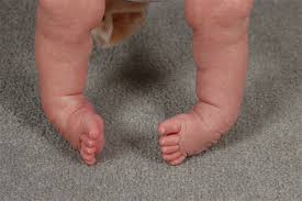 However, in these cases, the the contents of this site are for informational purposes only and are meant to be discussed with your physician or other qualified health care. Clubfoot Congenital Talipes Equinovarus Pediatrics Orthobullets
