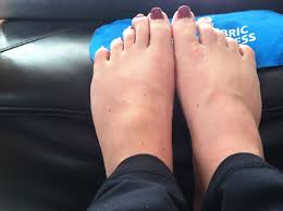 It is an overuse injury which is common in runners, especially if your shoes do not fit properly, or are laced too tight. Foot Issues Married And Marathoning