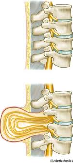 Spina Bifida Dictionary Definition Spina Bifida Defined Spina Bifida American Heritage Dictionary Medical Definition