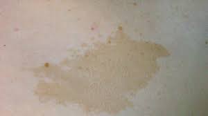 They are usually present at birth or appear during the first years of life. Cafe Au Lait Spots In Babies Differential Diagnosis And More