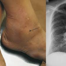 Image result for erythema nodosum